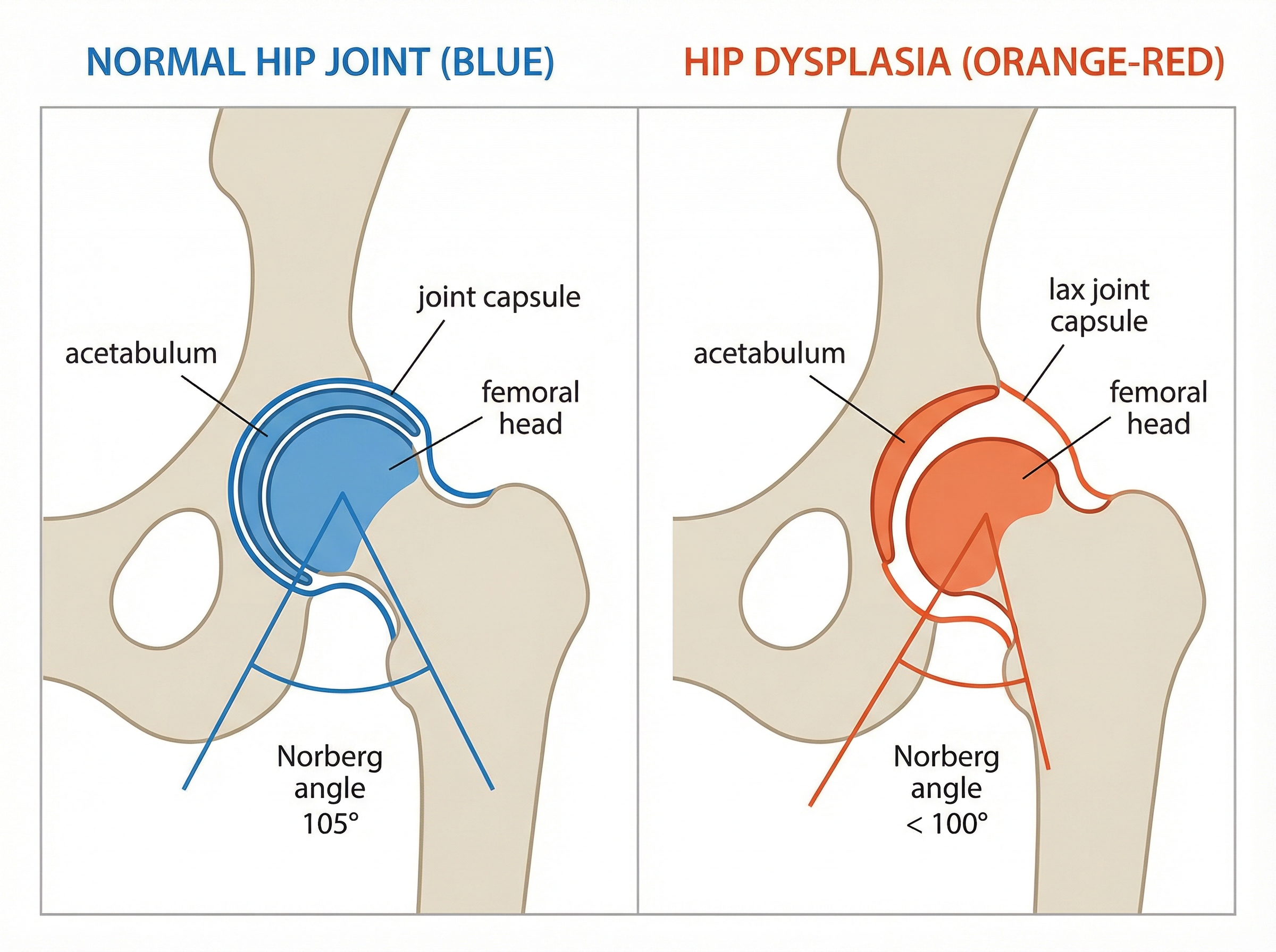 正常な股関節と股関節形成不全の比較図