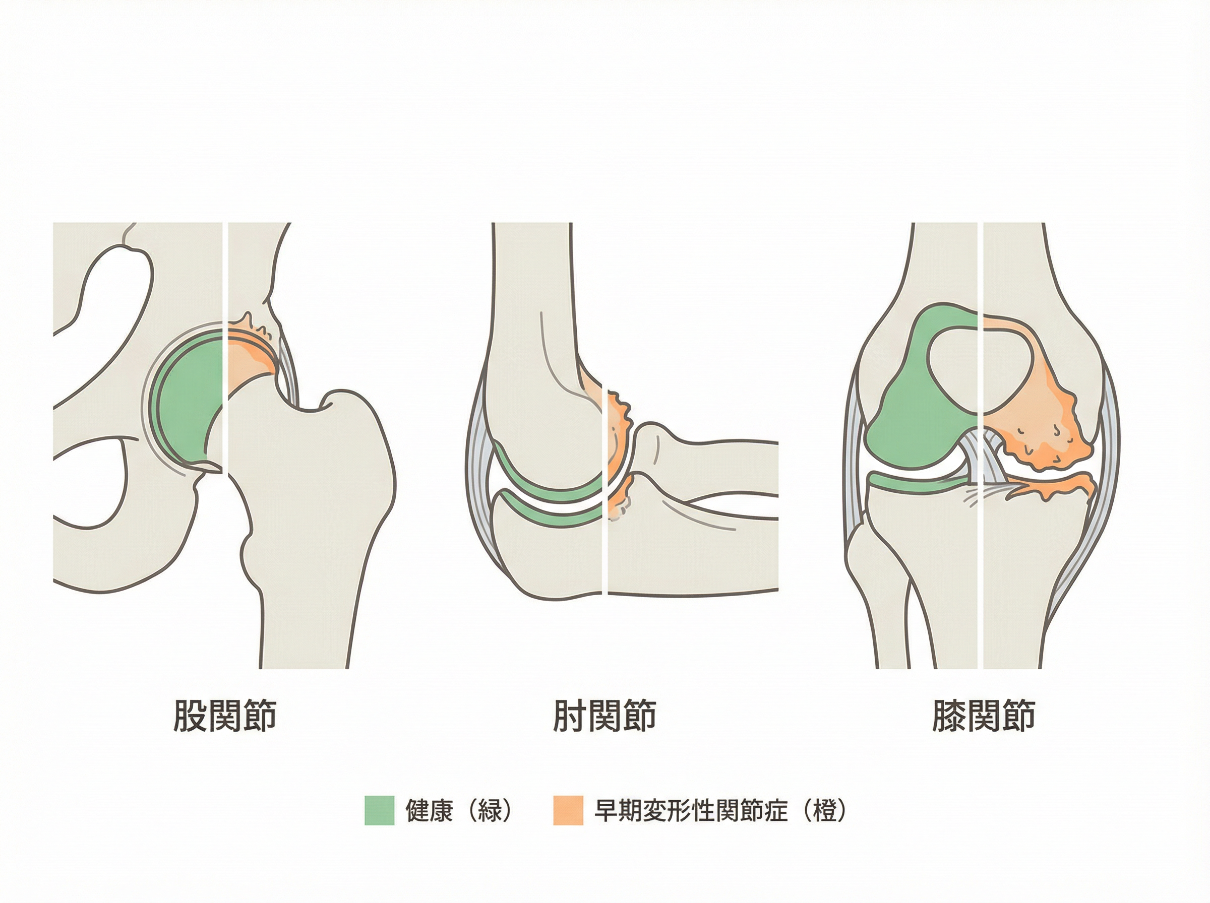 3大高リスク関節の解剖図（股関節・肘関節・膝関節、健常vs早期OA比較）